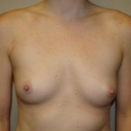 Before image 1 Case #79386 - Breast Augmentation