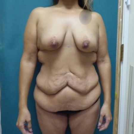 Before image 1 Case #86841 - Standard Abdominoplasty after massive weight loss