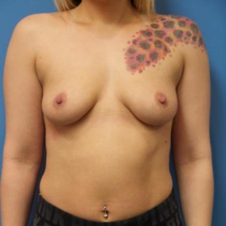 Before image 1 Case #84366 - Breast Augmentation