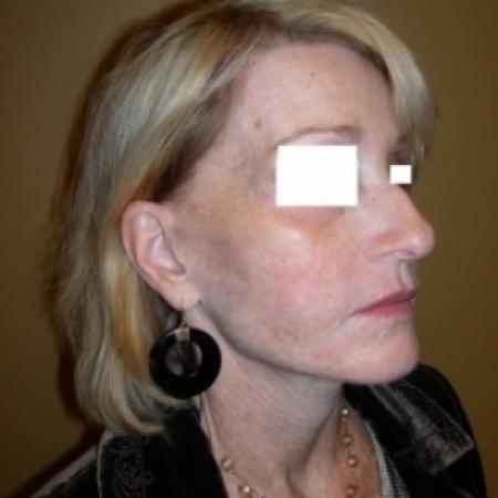 Before image 2 Case #79801 - Sculptra