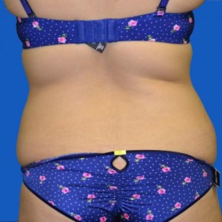 Before image 3 Case #87851 - Tummy Tuck