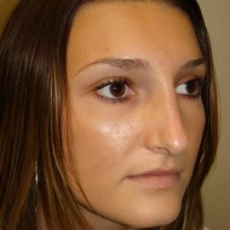 Before image 4 Case #79961 - Open Rhinoplasty