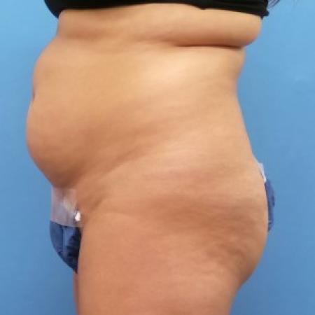 Before image 2 Case #86656 - Liposuction of Abdomen, Waist & Flanks - 3 months post-op