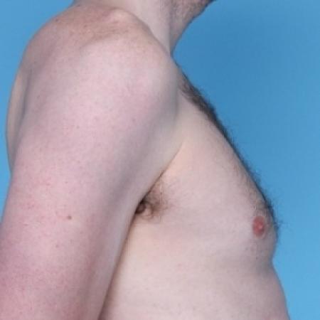 Before image 2 Case #79266 - Male Breast Reduction