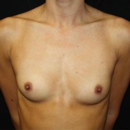 Before image 1 Case #85306 - Breast Augmentation - 27 year old female