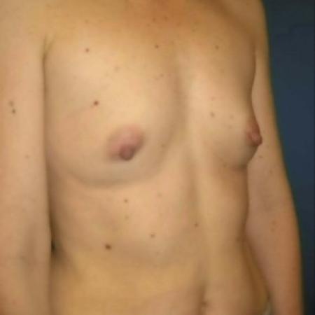 Before image 2 Case #82886 - Breast Augmentation using Memory Shape Gel Implants