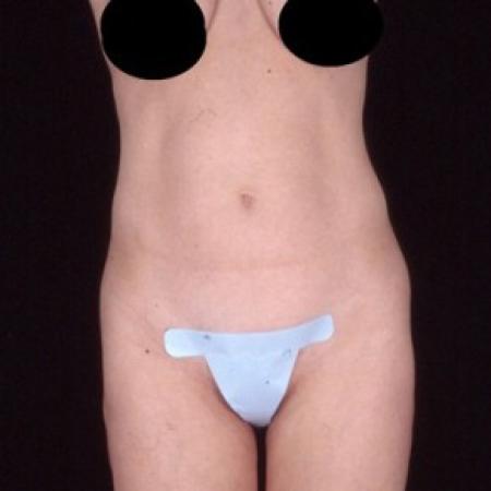 Before image 1 Case #81566 - Tummy Tuck