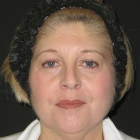 Before image 1 Case #82696 - 53 Year Old Woman's Facial Rejuvenation