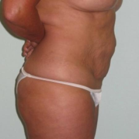 Before image 2 Case #79916 - Tummy Tuck