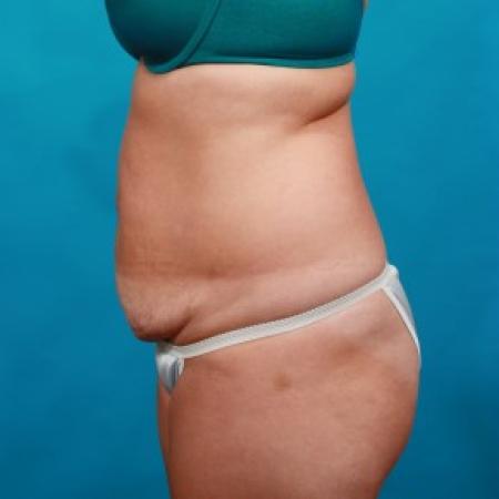 Before image 3 Case #85721 - Abdominoplasty with Flank Liposuction