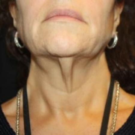 Before image 4 Case #85061 - Facelift and Neck Lift - 58 year old female