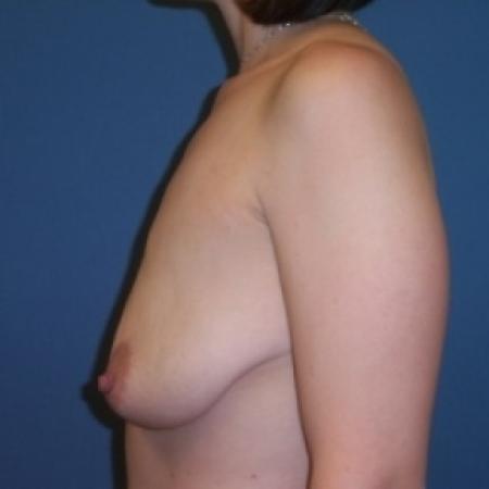 Before image 3 Case #80721 - Breast Lift with Augmentation