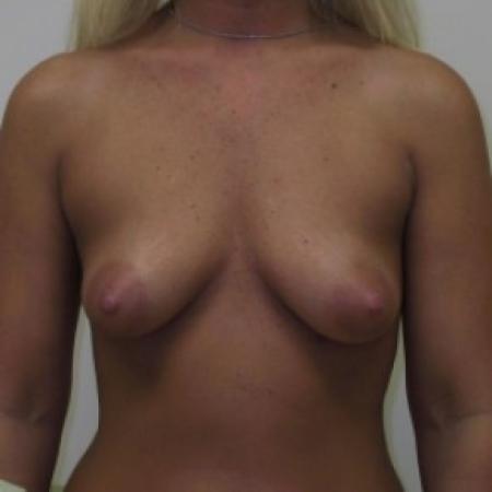 Before image 1 Case #81011 - Breast Augmentation