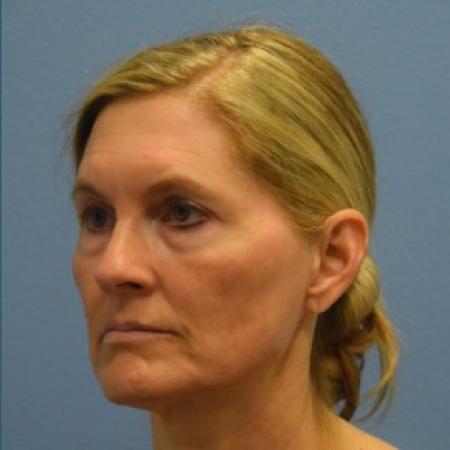 Before image 2 Case #86146 - Minimal Access Cranial Suspension (MACS) Lift