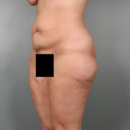 Before image 2 Case #83591 - Liposuction Abdomen and Thighs