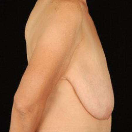 Before image 3 Case #81456 - Breast Reduction/Lift