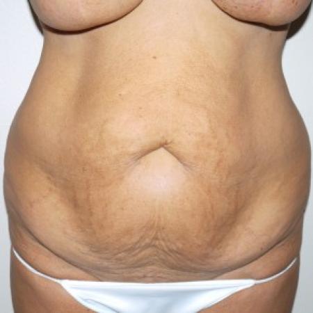 Before image 1 Case #82356 - 57 year old after tummy tuck