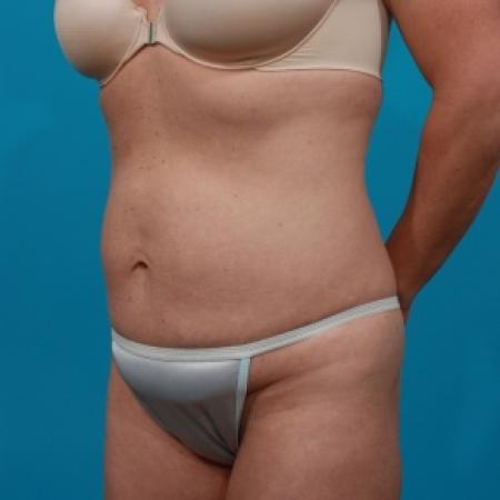 Before image 2 Case #80741 - Tummy Tuck