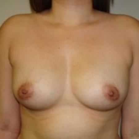Before image 1 Case #79446 - Breast Augmentation