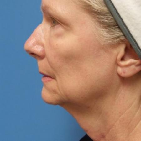 Before image 3 Case #86581 - Facelift/Upper Blepharoplasty     2 months post-op
