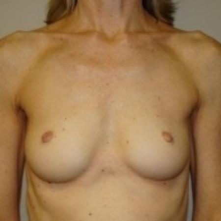 Before image 1 Case #79731 - Breast Augmentation