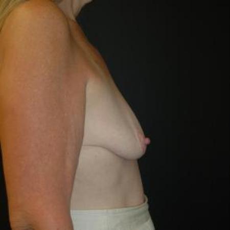 Before image 3 Case #80866 - Mastopexy with Breast Augmentation