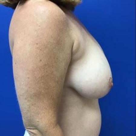 Before image 2 Case #88356 - Breast Reduction on a 48 year old female