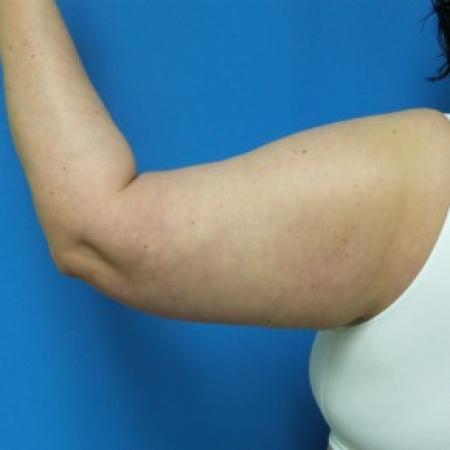 Before image 2 Case #86956 - 51 year old   -    Brachioplasty (Arm Lift)   -  5 months post-op