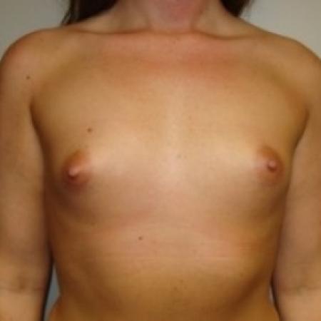 Before image 1 Case #79381 - Breast Augmentation