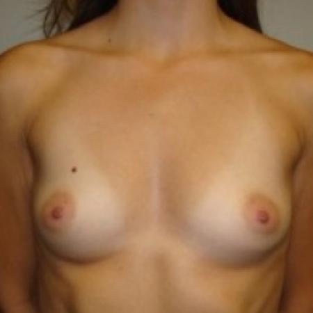 Before image 1 Case #79371 - Breast Augmentation