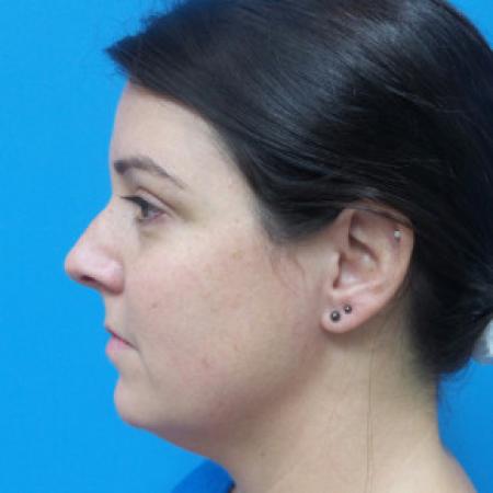 Before image 3 Case #88206 - 40 year old  -  Rhinoplasty & Septoplasty  -  1 month post-op