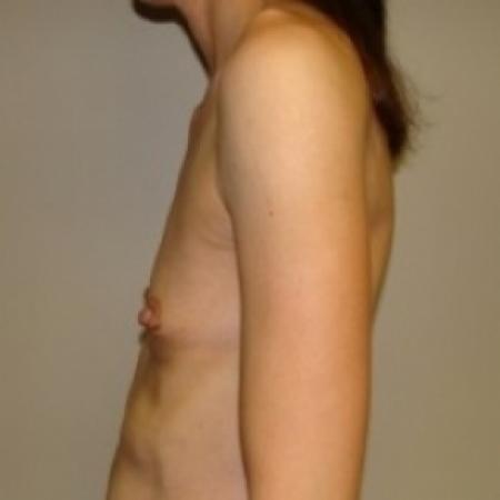 Before image 3 Case #79436 - Breast Augmentation