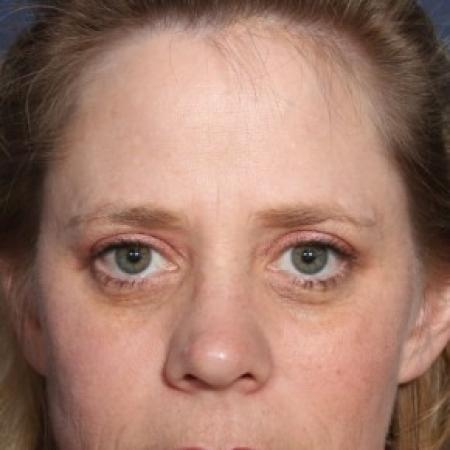 Before image 1 Case #84331 - 44 year old female