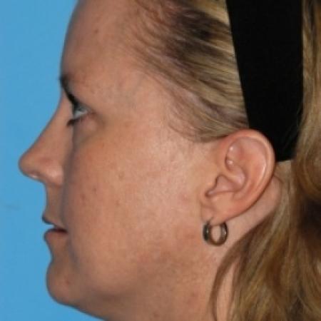 Before image 3 Case #79676 - Lip Grafting