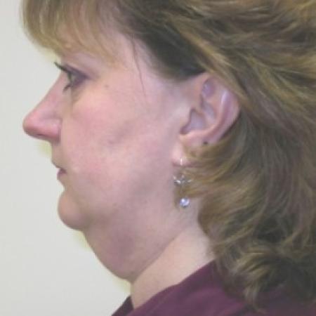 Before image 1 Case #81046 - Facelift