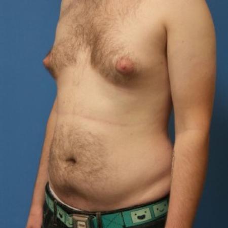 Before image 2 Case #86406 - Gynecomastia