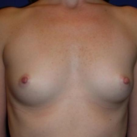 Before image 1 Case #79771 - Breast Enlargement with Silicone Implants