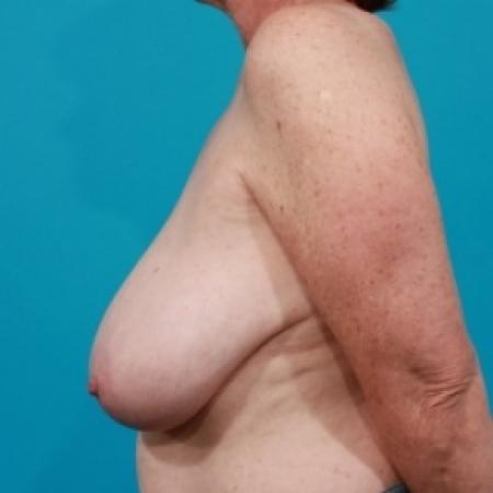 Before image 3 Case #78651 - Breast Reduction