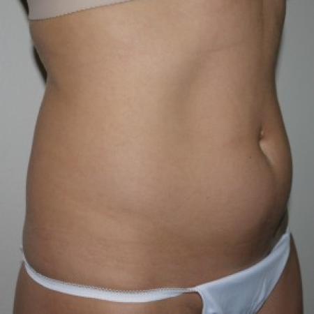 Before image 2 Case #82561 - Liposuction of the abdomen and hips