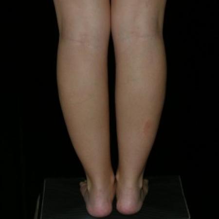 Before image 3 Case #81936 - Calf and Ankle Liposculpture