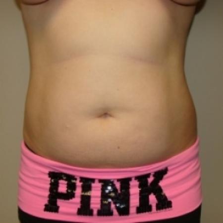 Before image 1 Case #79946 - Liposuction
