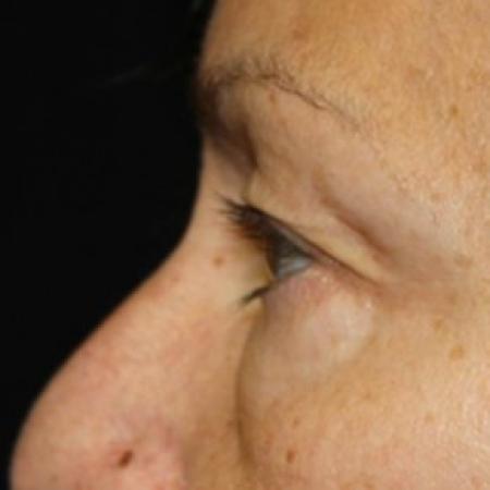 Before image 3 Case #83456 - Blepharoplasty - 57 year old female.