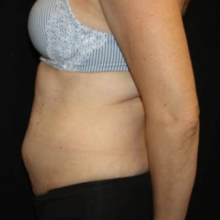 Before image 3 Case #83766 - Abdominoplasty - 47 year old female.