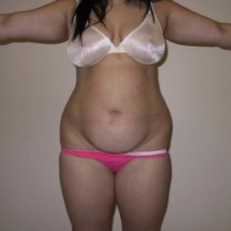 Before image 1 Case #81156 - Liposuction