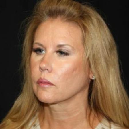 Before image 2 Case #85286 - Facelift and Neck Lift - 54 year old female