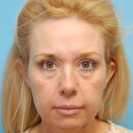 Before image 1 Case #82826 - Face Lift, Neck Lift, and Endoscopic Forehead Lift 