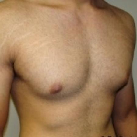 Before image 4 Case #79046 - Gynecomastia