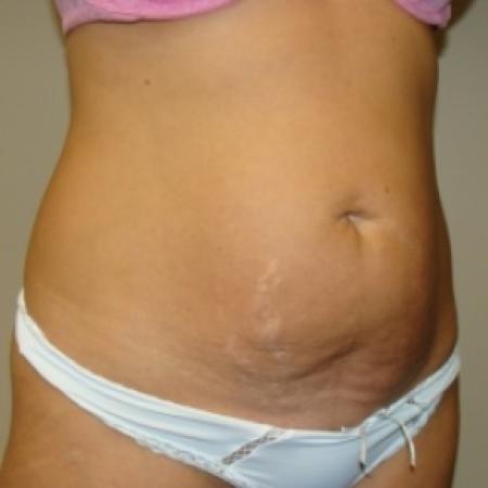 Before image 2 Case #80116 - Abdominoplasty