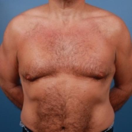 Before image 1 Case #79066 - Gynecomastia Treatment