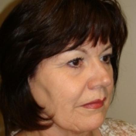 Before image 3 Case #79621 - Blepharoplasty